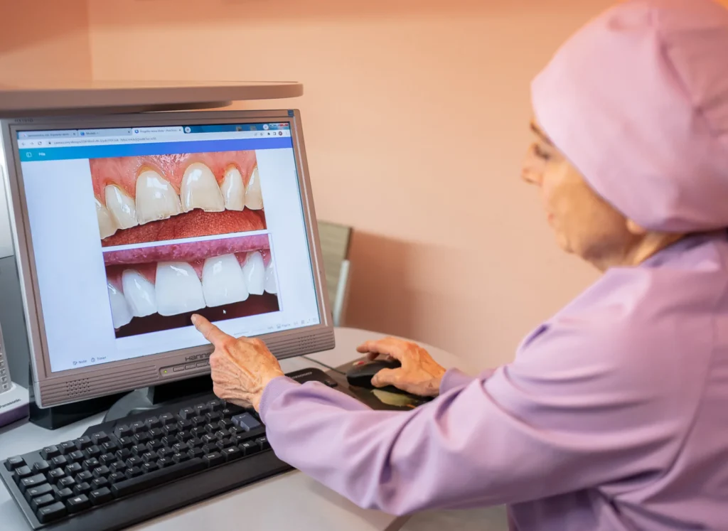 quanto durano le faccette dentali - sorrisi prima e dopo